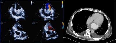 Case Report: Pericardial patch repair of mitral annulus and mitral valve for a left atrial dissection caused by parasitic infective endocarditis